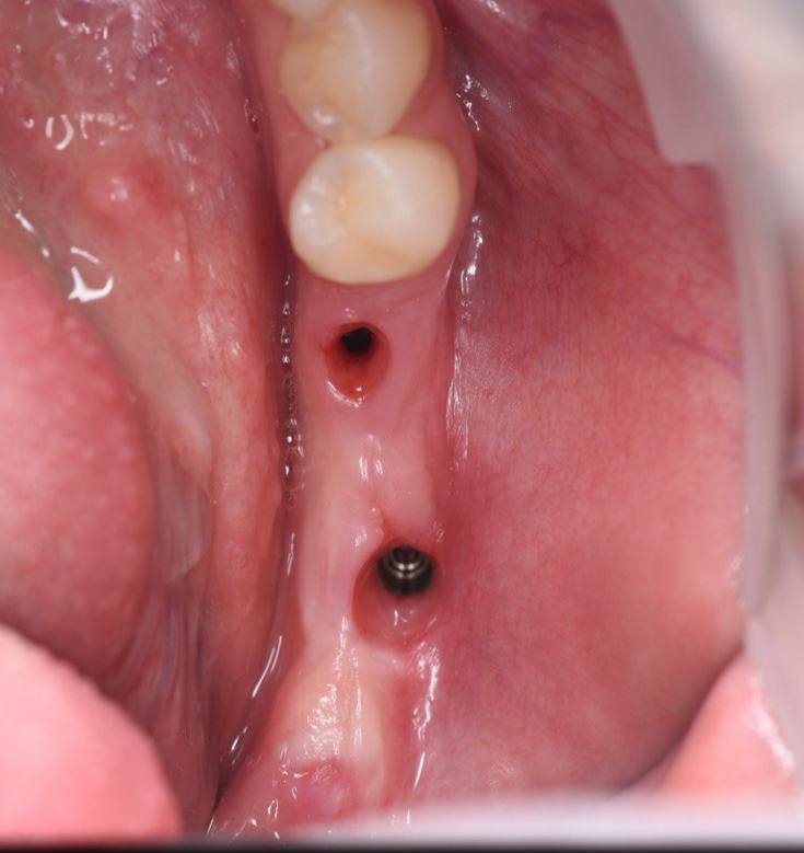 Implantatsiya
